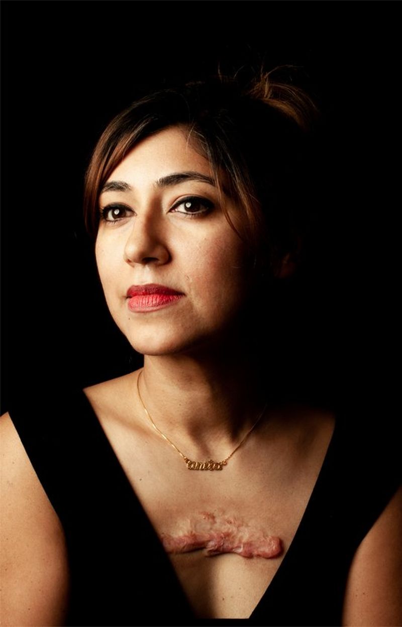 A brown-haired woman, wearing a V-neck top and gold necklace has a large keloid scar on her chest.